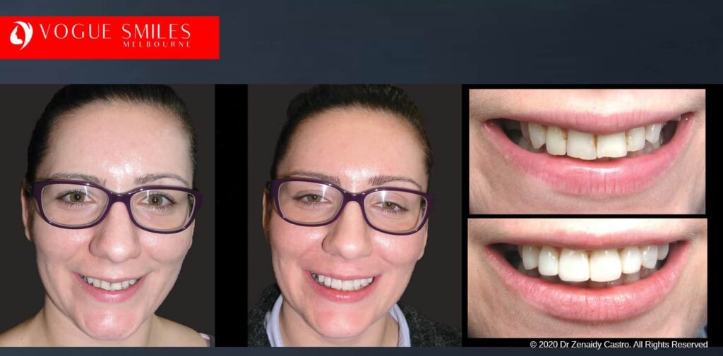 Close Front Teeth Gaps with Cosmetic Dental Bonding,Cheapest Cosmetic Dentist Near Me for Smile Makeovers, Cosmetic Dentistry in Noble Park North, Affordable Smile Makeover Dentistry in Noble Park North. General Dentist Noble Park North- Best Dentist in Noble Park North - Best Dental Clinic in Noble Park North, Best Cosmetic Dentist in Noble Park North. Serving surrounding suburbs Dandenong North, Mulgrave, Springvale, Springvale South, Noble Park, Rowville, Wheelers Hill, Keysborough, and Endeavour Hills, Mulgrave, Glen Waverly