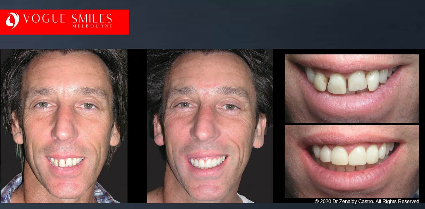 Same day Smiles - Instant Smile Makeover in One Visit, Cheapest Cosmetic Dentist Near Me for Smile Makeovers, Cosmetic Dentistry in Noble Park North, Affordable Smile Makeover Dentistry in Noble Park North. General Dentist Noble Park North- Best Dentist in Noble Park North - Best Dental Clinic in Noble Park North, Best Cosmetic Dentist in Noble Park North. Serving surrounding suburbs Dandenong North, Mulgrave, Springvale, Springvale South, Noble Park, Rowville, Wheelers Hill, Keysborough, and Endeavour Hills, Mulgrave, Glen Waverly