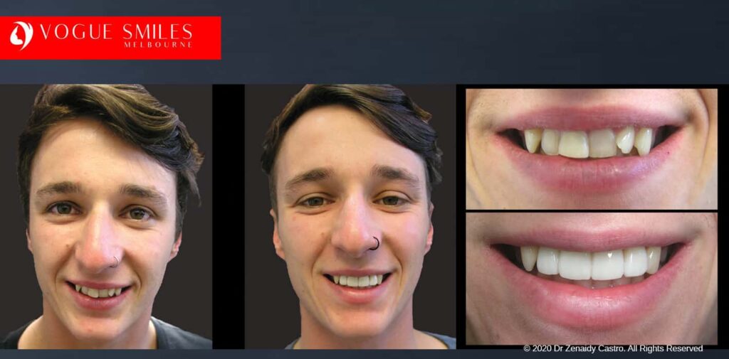Porcelain Veneers – Fast Alternative to Braces, Cheapest Cosmetic Dentist Near Me for Smile Makeovers, Cosmetic Dentist in Noble Park North, Affordable Smile Makeover Dentistry in Noble Park North. General Dentist Noble Park North- Best Dentist in Noble Park North - Best Dental Clinic in Noble Park North, Best Cosmetic Dentist in Noble Park North. Serving surrounding suburbs Dandenong North, Mulgrave, Springvale, Springvale South, Noble Park, Rowville, Wheelers Hill, Keysborough, and Endeavour Hills, Mulgrave, Glen Waverly