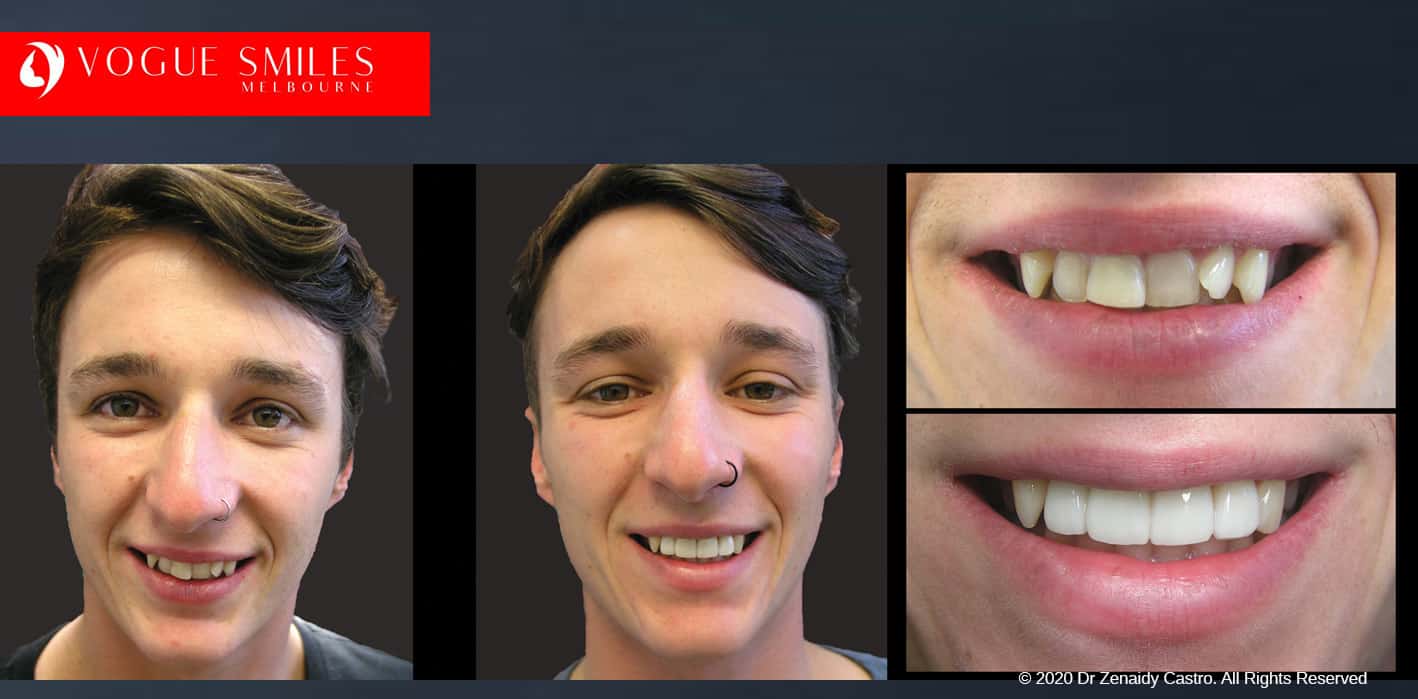 Porcelain Veneers – Fast Alternative to Braces, Cheapest Cosmetic Dentist Near Me for Smile Makeovers, Cosmetic Dentist in Noble Park North, Affordable Smile Makeover Dentistry in Noble Park North. General Dentist Noble Park North- Best Dentist in Noble Park North - Best Dental Clinic in Noble Park North, Best Cosmetic Dentist in Noble Park North. Serving surrounding suburbs Dandenong North, Mulgrave, Springvale, Springvale South, Noble Park, Rowville, Wheelers Hill, Keysborough, and Endeavour Hills, Mulgrave, Glen Waverly