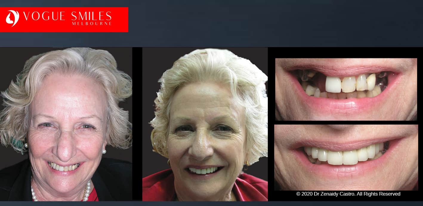 Implant vs Bridge: dental implants, dental bridges, tooth replacement, Tooth replacement options comparison, Missing tooth replacement option and cost, Cheapest Cosmetic Dentist Near Me for Smile Makeovers, Cosmetic Dentistry in Noble Park North, Affordable Smile Makeover Dentistry in Noble Park North. General Dentist Noble Park North- Best Dentist in Noble Park North - Best Dental Clinic in Noble Park North, Best Cosmetic Dentist in Noble Park North. Serving surrounding suburbs Dandenong North, Mulgrave, Springvale, Springvale South, Noble Park, Rowville, Wheelers Hill, Keysborough, and Endeavour Hills, Mulgrave, Glen Waverly