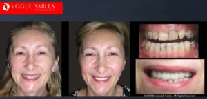 Signs Your Dental Crown Needs Repair or Replacement, Cheapest Cosmetic Dentist Near Me for Smile Makeovers, Cosmetic Dentistry in Noble Park North, Affordable Smile Makeover Dentistry in Noble Park North. General Dentist Noble Park North- Best Dentist in Noble Park North - Best Dental Clinic in Noble Park North, Best Cosmetic Dentist in Noble Park North. Serving surrounding suburbs Dandenong North, Mulgrave, Springvale, Springvale South, Noble Park, Rowville, Wheelers Hill, Keysborough, and Endeavour Hills, Mulgrave, Glen Waverly