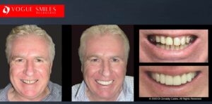 Affordable Alternatives to Dental Implants in Melbourne, Cheapest Cosmetic Dentist Near Me for Smile Makeovers, Cosmetic Dentistry in Noble Park North, Affordable Smile Makeover Dentistry in Noble Park North. General Dentist Noble Park North- Best Dentist in Noble Park North - Best Dental Clinic in Noble Park North, Best Cosmetic Dentist in Noble Park North. Serving surrounding suburbs Dandenong North, Mulgrave, Springvale, Springvale South, Noble Park, Rowville, Wheelers Hill, Keysborough, and Endeavour Hills, Mulgrave, Glen Waverly
