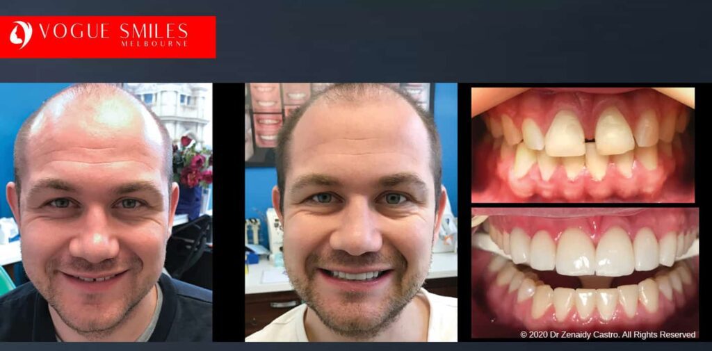 Dental Bonding vs Veneers - Melbourne Smile Solutions, Cheapest Cosmetic Dentist Near Me for Smile Makeovers, Cosmetic Dentistry in Noble Park North, Affordable Smile Makeover Dentistry in Noble Park North. General Dentist Noble Park North- Best Dentist in Noble Park North - Best Dental Clinic in Noble Park North, Best Cosmetic Dentist in Noble Park North. Serving surrounding suburbs Dandenong North, Mulgrave, Springvale, Springvale South, Noble Park, Rowville, Wheelers Hill, Keysborough, and Endeavour Hills, Mulgrave, Glen Waverly