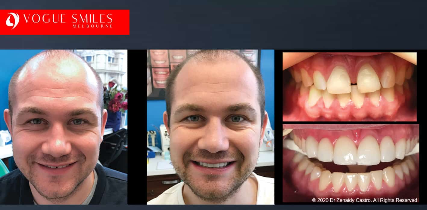 Dental Bonding vs Veneers - Melbourne Smile Solutions, Cheapest Cosmetic Dentist Near Me for Smile Makeovers, Cosmetic Dentistry in Noble Park North, Affordable Smile Makeover Dentistry in Noble Park North. General Dentist Noble Park North- Best Dentist in Noble Park North - Best Dental Clinic in Noble Park North, Best Cosmetic Dentist in Noble Park North. Serving surrounding suburbs Dandenong North, Mulgrave, Springvale, Springvale South, Noble Park, Rowville, Wheelers Hill, Keysborough, and Endeavour Hills, Mulgrave, Glen Waverly