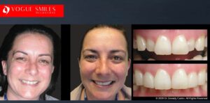 Get Dental Veneer Discounts – Melbourne & Noble Park North. Cheapest Cosmetic Dentist Near Me for Smile Makeovers, Cosmetic Dentistry in Noble Park North, Affordable Smile Makeover Dentistry in Noble Park North. General Dentist Noble Park North- Best Dentist in Noble Park North - Best Dental Clinic in Noble Park North, Best Cosmetic Dentist in Noble Park North. Serving surrounding suburbs Dandenong North, Mulgrave, Springvale, Springvale South, Noble Park, Rowville, Wheelers Hill, Keysborough, and Endeavour Hills, Mulgrave, Glen Waverly