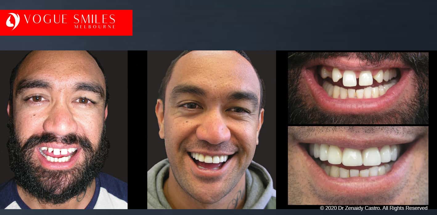 Choosing Dental Veneers: Composite or Porcelain? Cheapest Cosmetic Dentist Near Me for Smile Makeovers, Cosmetic Dentistry in Noble Park North, Affordable Smile Makeover Dentistry in Noble Park North. General Dentist Noble Park North- Best Dentist in Noble Park North - Best Dental Clinic in Noble Park North, Best Cosmetic Dentist in Noble Park North. Serving surrounding suburbs Dandenong North, Mulgrave, Springvale, Springvale South, Noble Park, Rowville, Wheelers Hill, Keysborough, and Endeavour Hills, Mulgrave, Glen Waverly