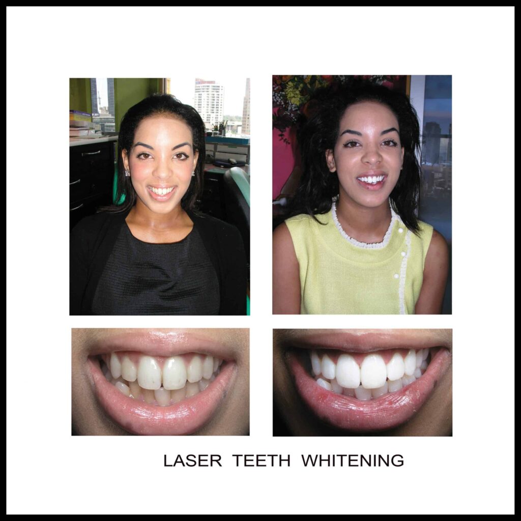Risks of Teeth Whitening at Beauty Salons & Non-Dental Sites