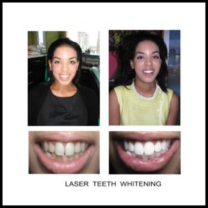 Risks of Teeth Whitening at Beauty Salons & Non-Dental Sites