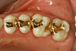 Gold Inlays, Gold Onlays Fillings and Gold Crowns Melbourne 