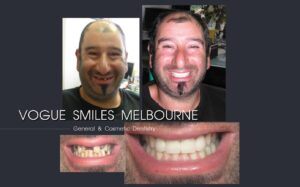 Emergency Tooth Repair for Chips, Cracks & Breaks, Cheapest Cosmetic Dentist Near Me for Smile Makeovers, Cosmetic Dentistry in Noble Park North, Affordable Smile Makeover Dentistry in Noble Park North. General Dentist Noble Park North- Best Dentist in Noble Park North - Best Dental Clinic in Noble Park North, Best Cosmetic Dentist in Noble Park North. Serving surrounding suburbs Dandenong North, Mulgrave, Springvale, Springvale South, Noble Park, Rowville, Wheelers Hill, Keysborough, and Endeavour Hills, Mulgrave, Glen Waverly
