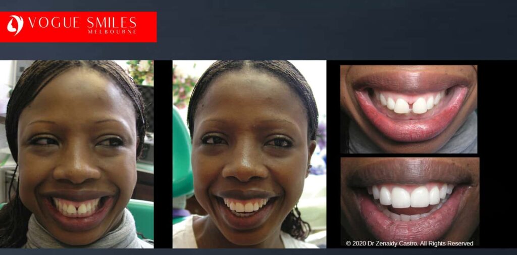 Beautiful Smile with Front Teeth Spacing Correction, Gappy Teeth Treatment in Melbourne with Porcelain Veneers, Cheapest Cosmetic Dentist Near Me for Smile Makeovers, Cosmetic Dentistry in Noble Park North, Affordable Smile Makeover Dentistry in Noble Park North. General Dentist Noble Park North- Best Dentist in Noble Park North - Best Dental Clinic in Noble Park North, Best Cosmetic Dentist in Noble Park North. Serving surrounding suburbs Dandenong North, Mulgrave, Springvale, Springvale South, Noble Park, Rowville, Wheelers Hill, Keysborough, and Endeavour Hills, Mulgrave, Glen Waverly