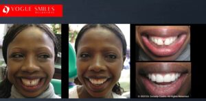 Beautiful Smile with Front Teeth Spacing Correction, Gappy Teeth Treatment in Melbourne with Porcelain Veneers, Cheapest Cosmetic Dentist Near Me for Smile Makeovers, Cosmetic Dentistry in Noble Park North, Affordable Smile Makeover Dentistry in Noble Park North. General Dentist Noble Park North- Best Dentist in Noble Park North - Best Dental Clinic in Noble Park North, Best Cosmetic Dentist in Noble Park North. Serving surrounding suburbs Dandenong North, Mulgrave, Springvale, Springvale South, Noble Park, Rowville, Wheelers Hill, Keysborough, and Endeavour Hills, Mulgrave, Glen Waverly