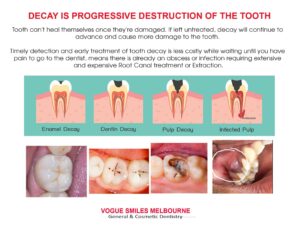 Cavity and Dental Decay Treatment in Noble Park North, Cheapest Cosmetic Dentist Near Me for Smile Makeovers, Cosmetic Dentistry in Noble Park North, Affordable Smile Makeover Dentistry in Noble Park North. General Dentist Noble Park North- Best Dentist in Noble Park North - Best Dental Clinic in Noble Park North, Best Cosmetic Dentist in Noble Park North. Serving surrounding suburbs Dandenong North, Mulgrave, Springvale, Springvale South, Noble Park, Rowville, Wheelers Hill, Keysborough, and Endeavour Hills, Mulgrave, Glen Waverly