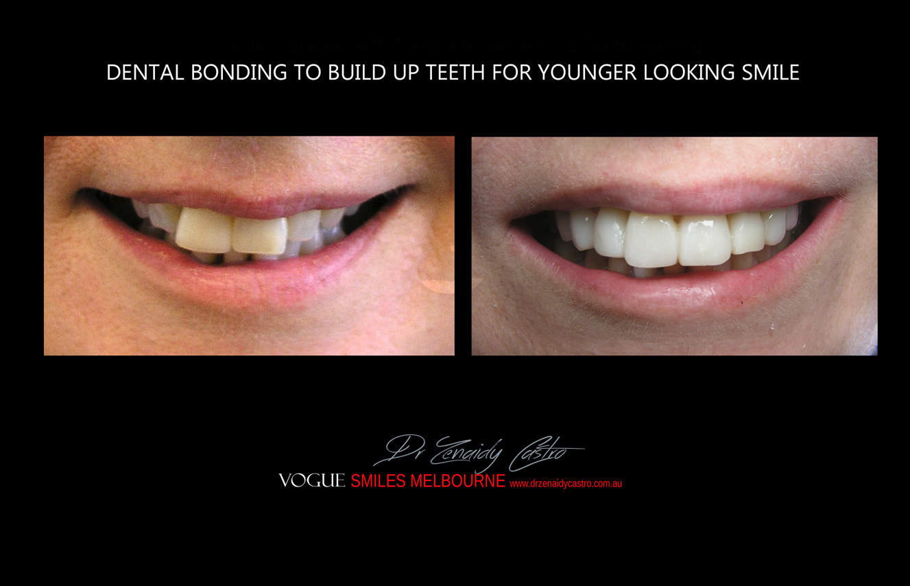 Affordable-Cheap-Cosmetic-Smile-Makeover