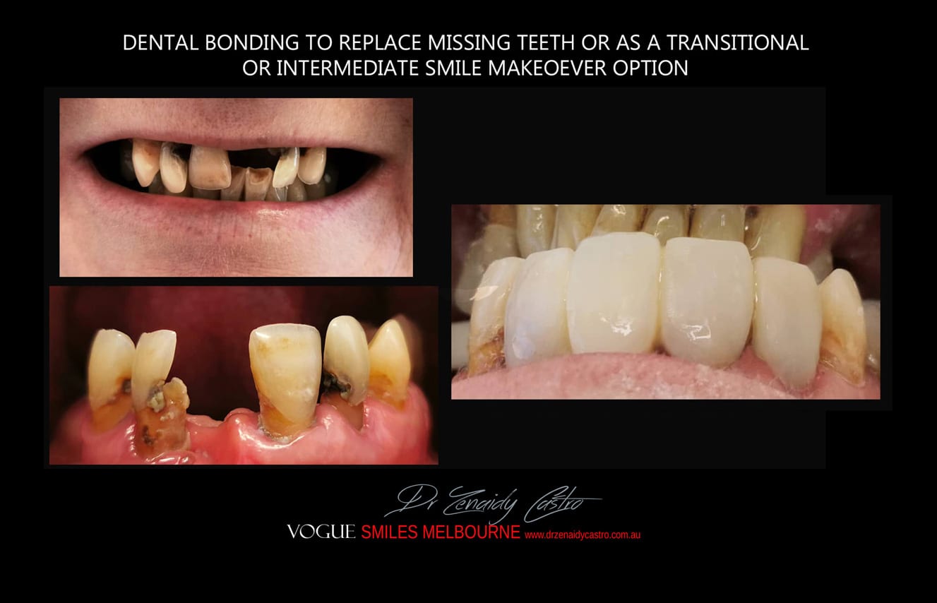 Affordable-Cheap-Cosmetic-Smile-Makeover