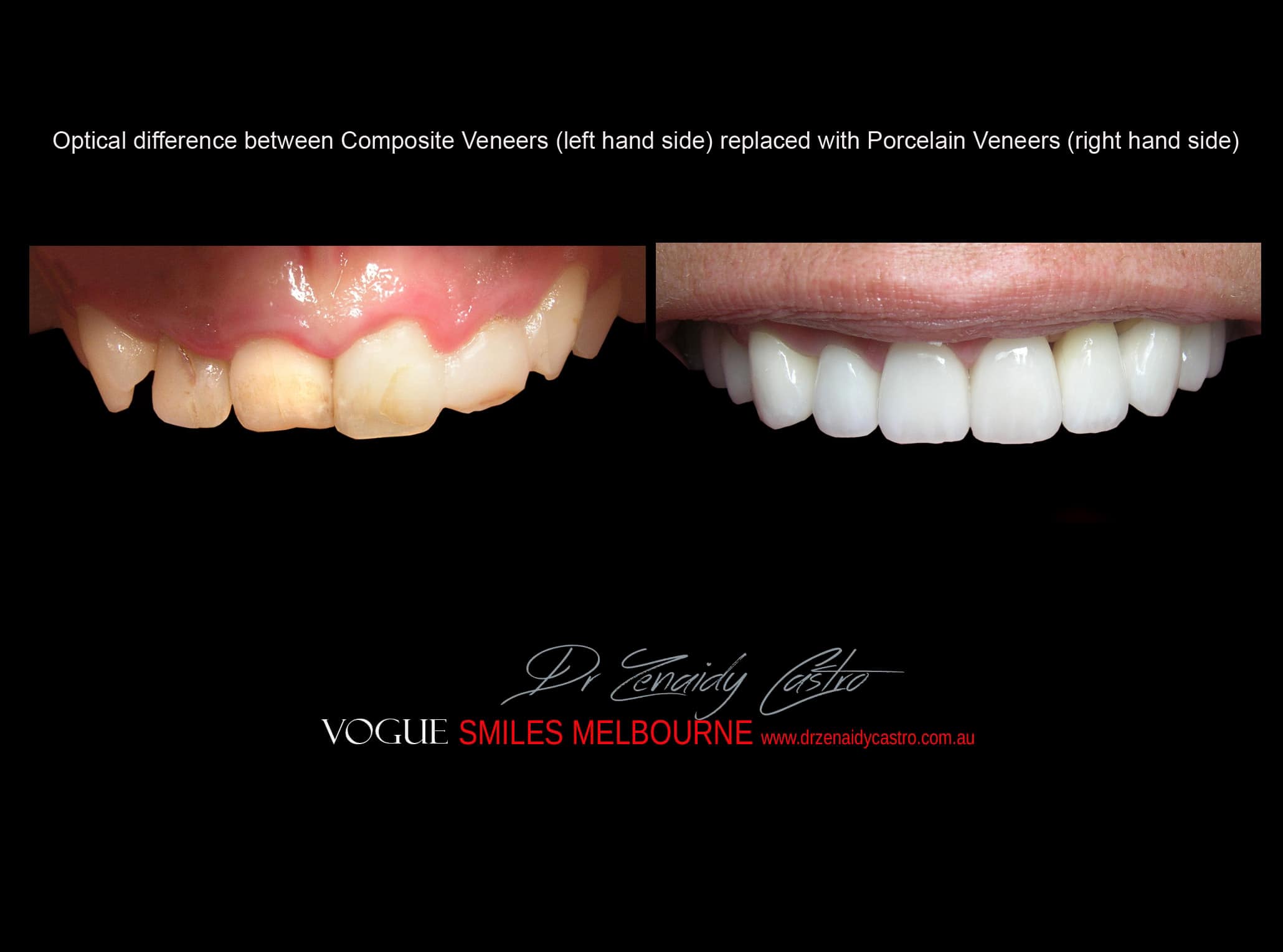 Affordable-Cheap-Cosmetic-Smile-Makeover