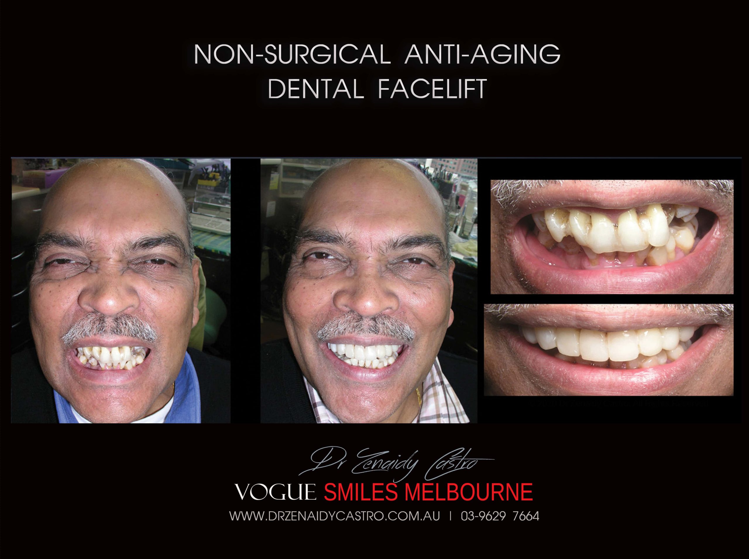 Affordable-Cheap-Cosmetic-Smile-Makeover