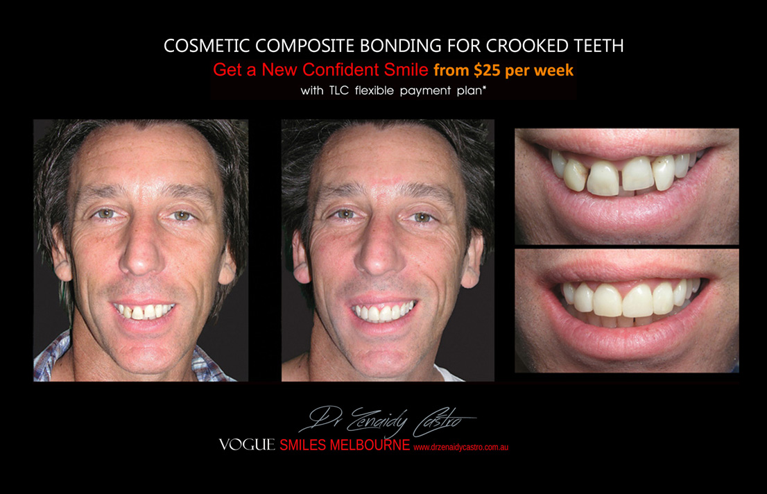 Affordable-Cheap-Cosmetic-Smile-Makeover