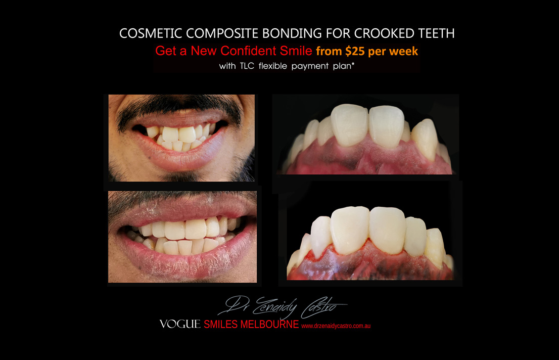 Affordable-Cheap-Cosmetic-Smile-Makeover