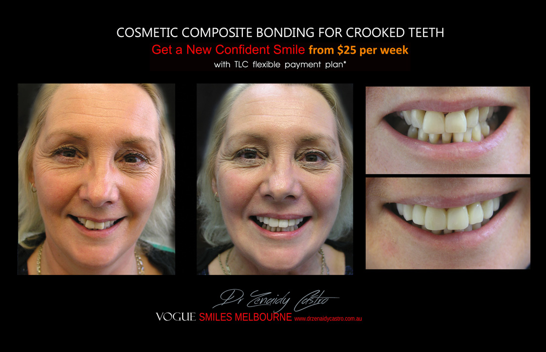 Affordable-Cheap-Cosmetic-Smile-Makeover