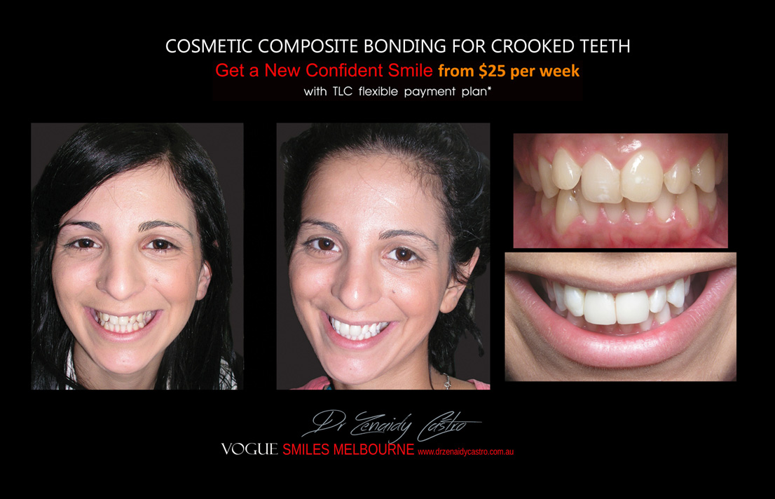 Choosing How Many Teeth for Veneers Treatment