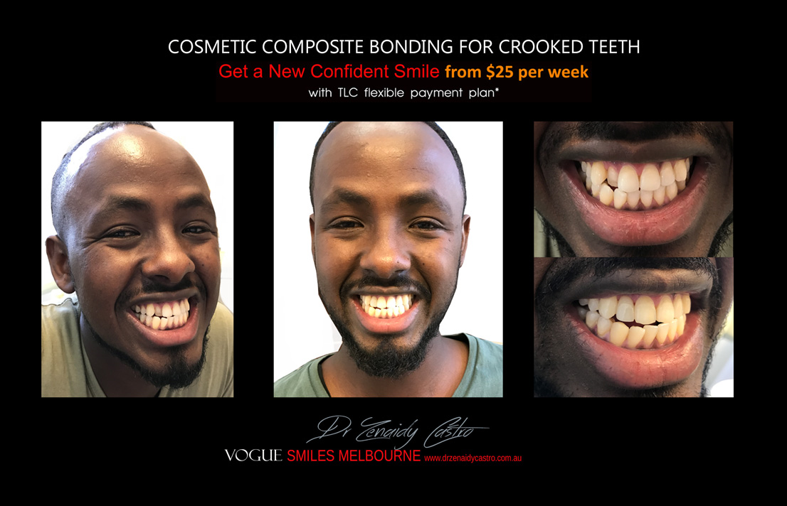 Affordable-Cheap-Cosmetic-Smile-Makeover
