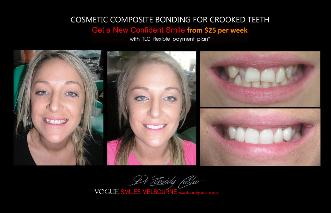 Affordable-Cheap-Cosmetic-Smile-Makeover