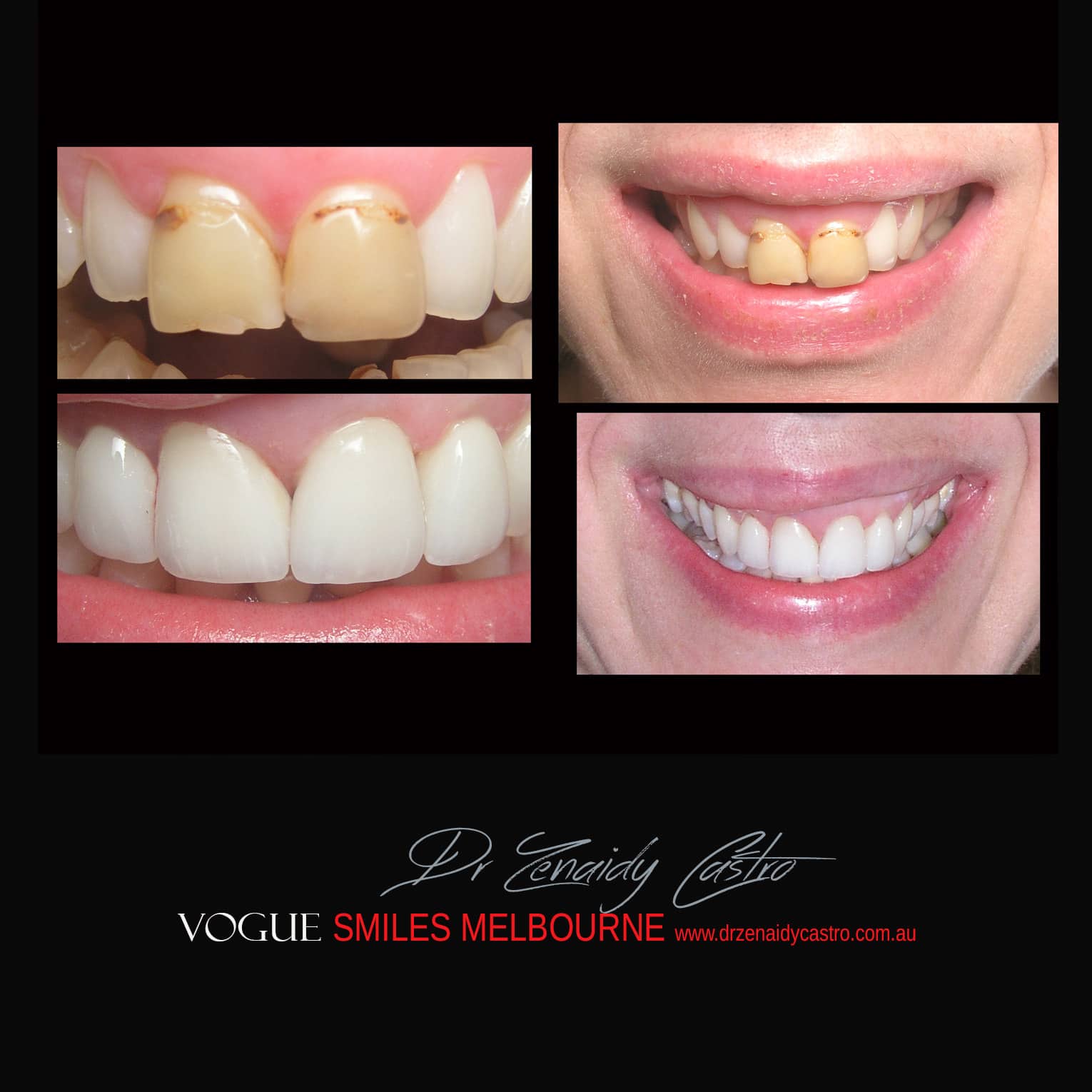 BLACK-TOOTH-DEAD-FRONT-TOOTH