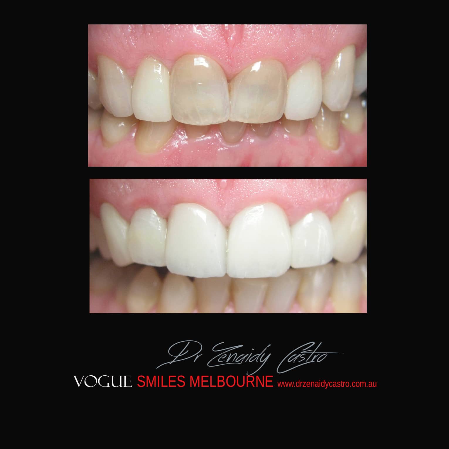 BLACK-TOOTH-DEAD-FRONT-TOOTH
