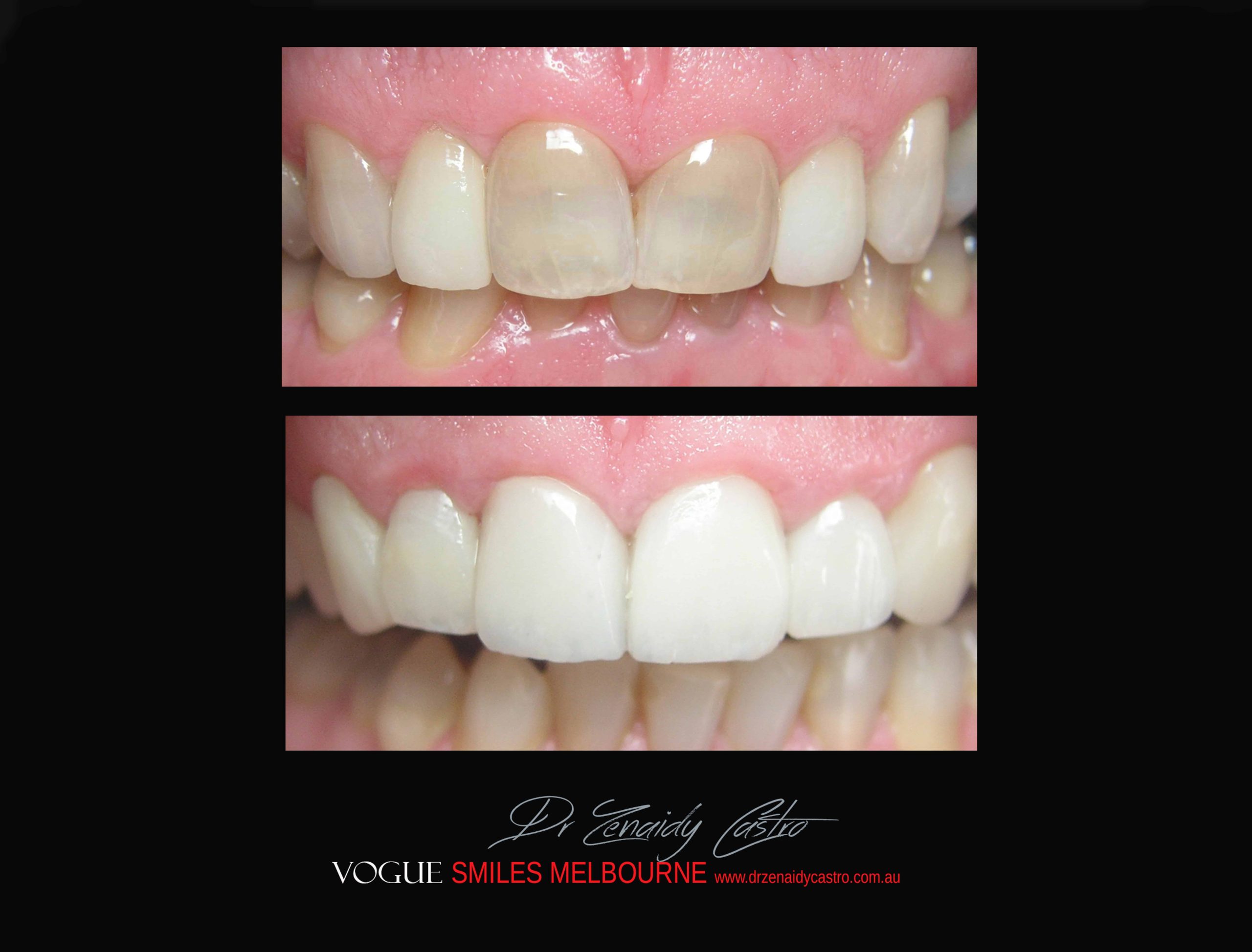 BLACK-TOOTH-DEAD-FRONT-TOOTH