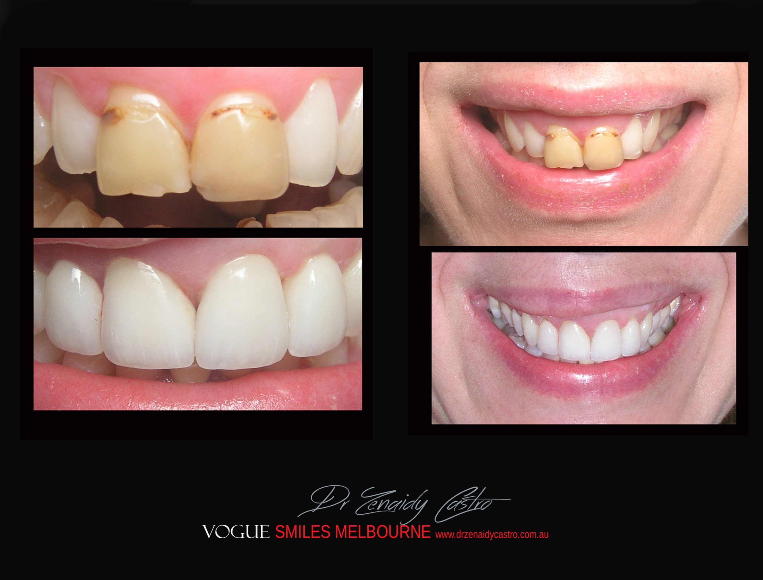 BLACK-TOOTH-DEAD-FRONT-TOOTH