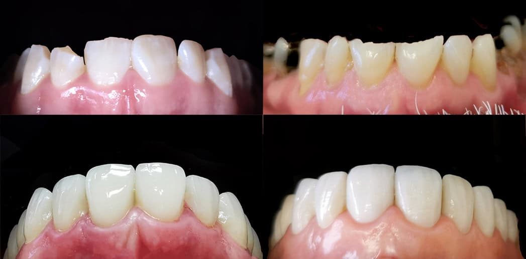 Smile Makeover Dentistry Procedures in Noble Park North, GLEN WAVERLEY, MULGRAVE, JACKSON ROAD, DANDENONG, SPRINGVALE