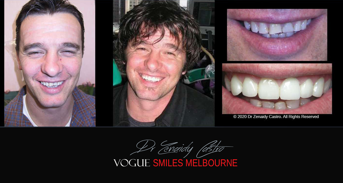 Smile Makeover near Glen Waverley area, Smile Makeover Cosmetic Dentist in Glen Waverley