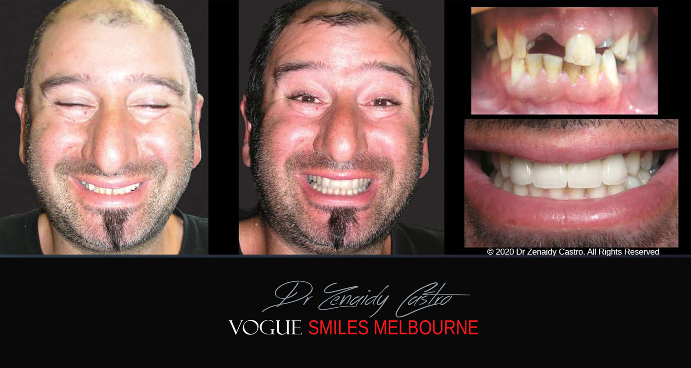 Smile Makeover near Glen Waverley area, Smile Makeover Cosmetic Dentist in Glen Waverley