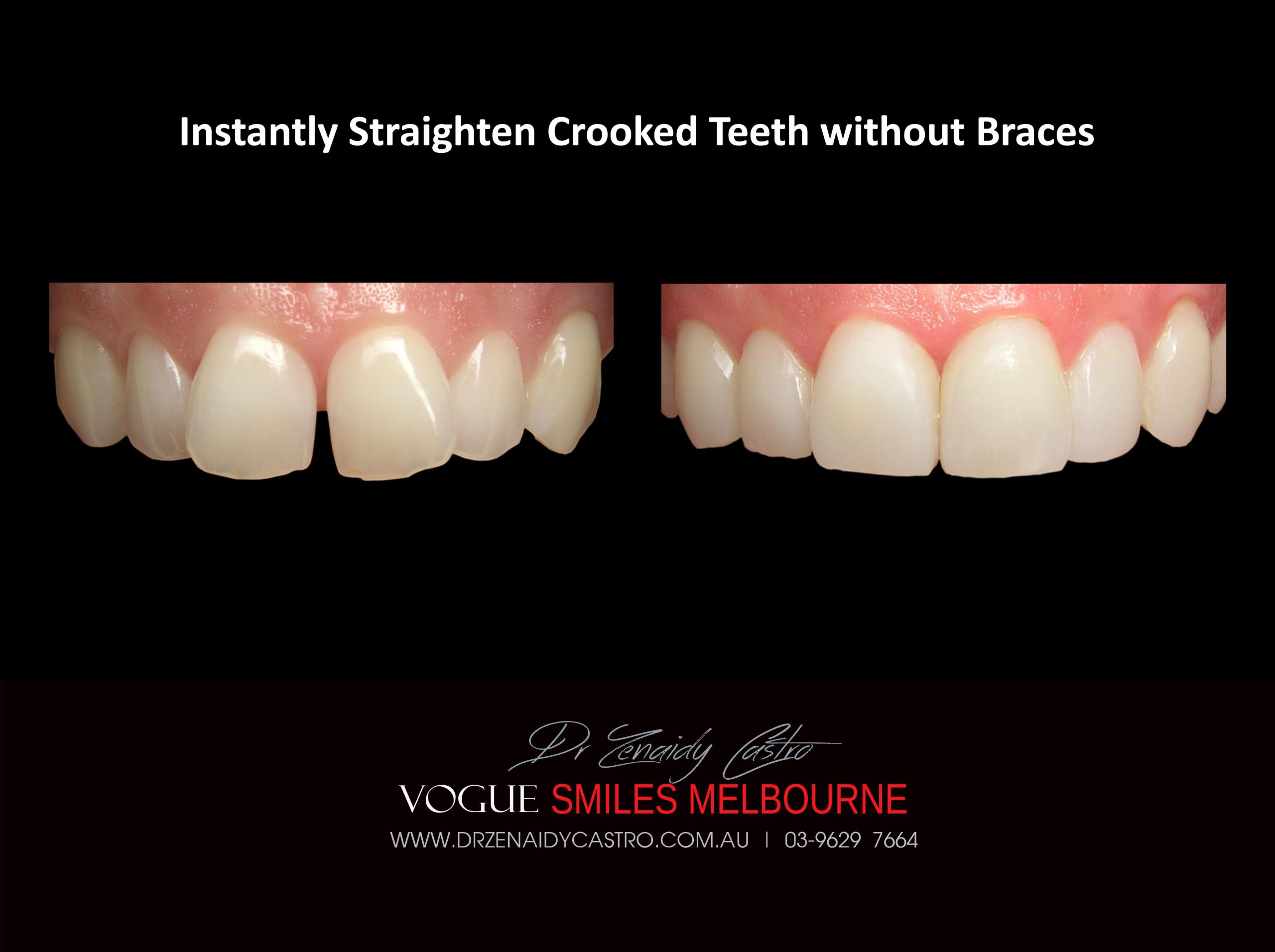 Fix Crooked Teeth - Instant Teeth Straightening with Porcelain Veneers -Family Cosmetic Dental Practice - Noble Park North Dentist