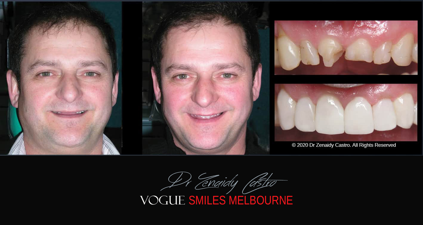 Composite Resin Veneers near Jackson Road Noble Park North - Dental bonding Composite Veneers in Jackson Road Noble Park North