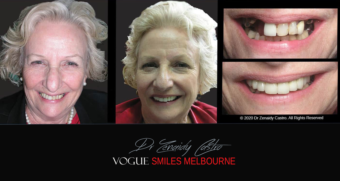 Look younger. Aged Smiles, Anti- Aging Dental Facelift in Noble Park North, Springvale, Dandenong