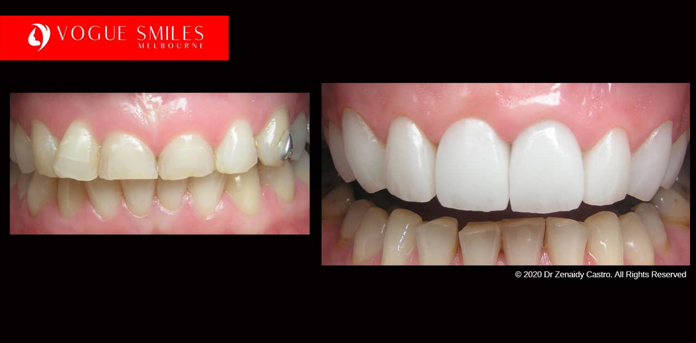 Full-Mouth-Reconstruction-complete-extreme-dental-makeover