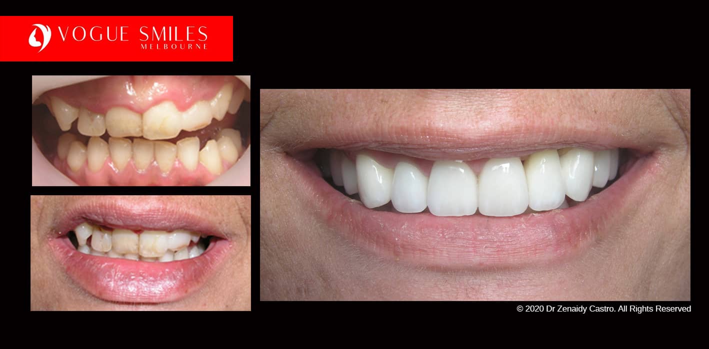 Full-Mouth-Reconstruction-complete-extreme-dental-makeover