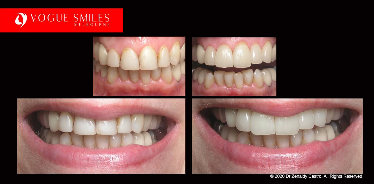 Full-Mouth-Reconstruction-complete-extreme-dental-makeover