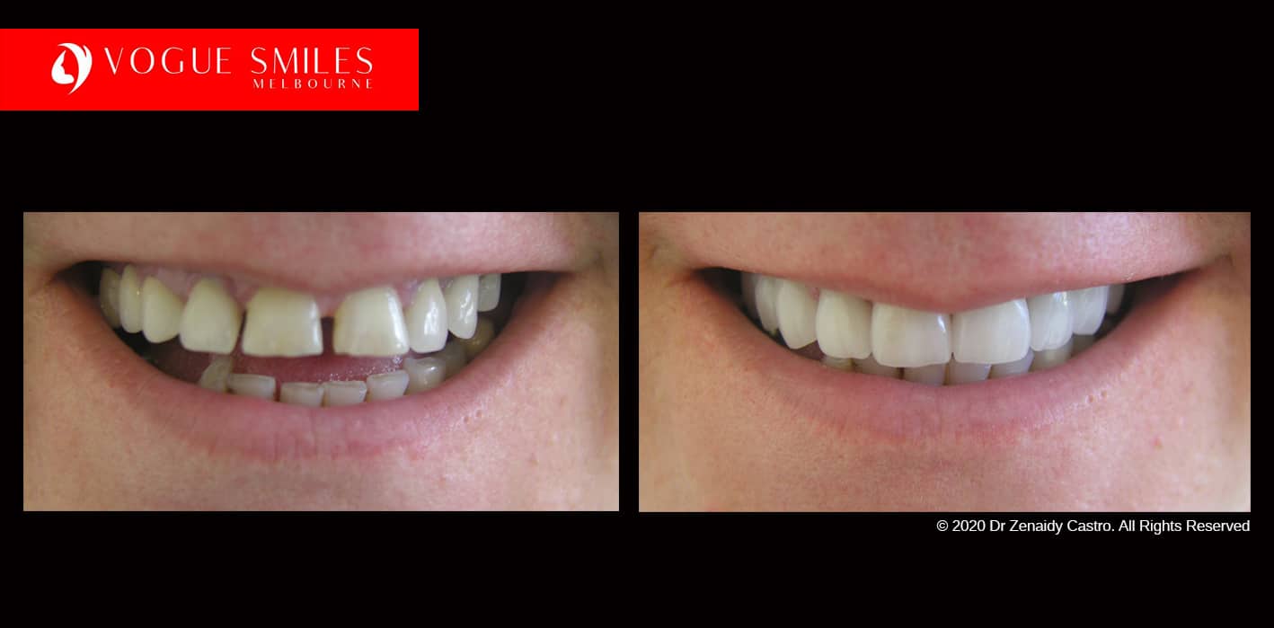 Full-Mouth-Reconstruction-complete-extreme-dental-makeover