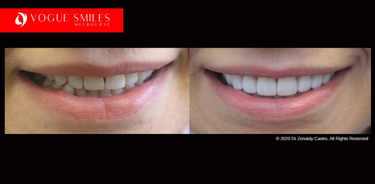 Vogue Smiles Melbourne - Vogue Dentist - Vogue Dental Melbourne -Best Cosmetic dentist in Noble park North and Melbourne CBD
