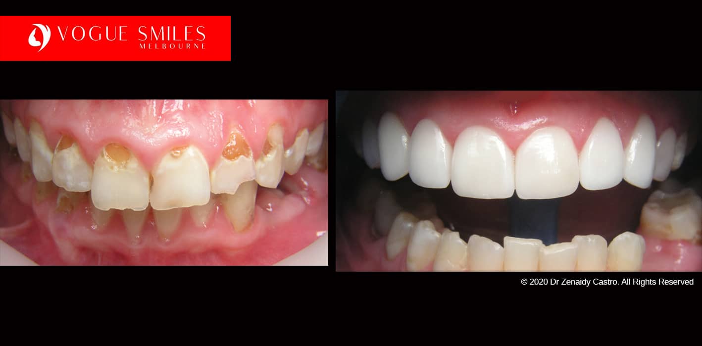 Full-Mouth-Reconstruction-complete-extreme-dental-makeover