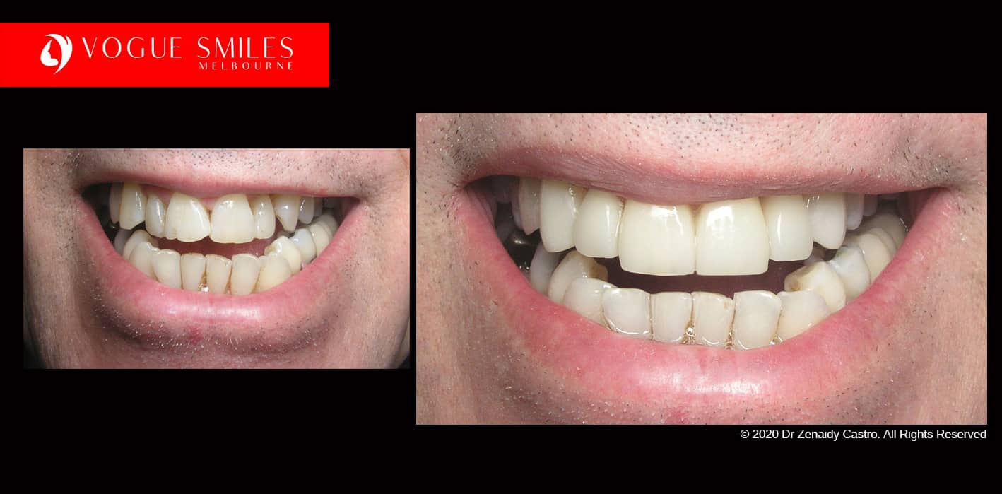 Full-Mouth-Reconstruction-complete-extreme-dental-makeover