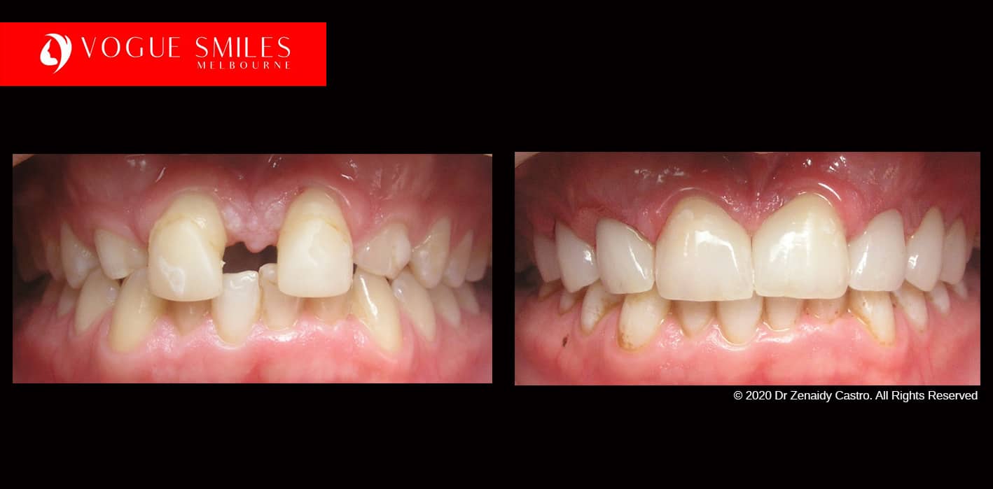Full-Mouth-Reconstruction-complete-extreme-dental-makeover