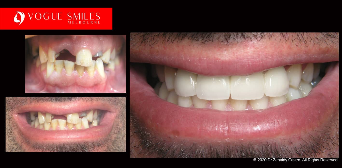Full-Mouth-Reconstruction-complete-extreme-dental-makeover
