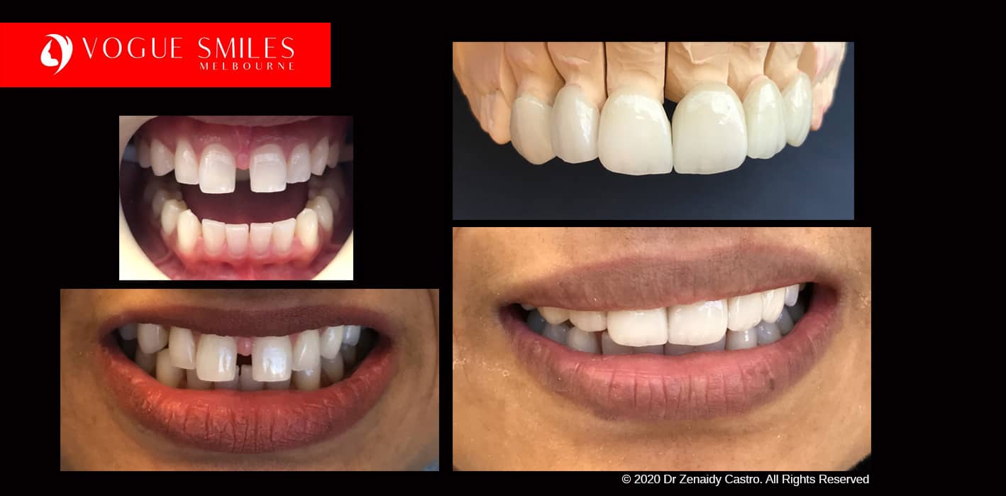 Full-Mouth-Reconstruction-complete-extreme-dental-makeover