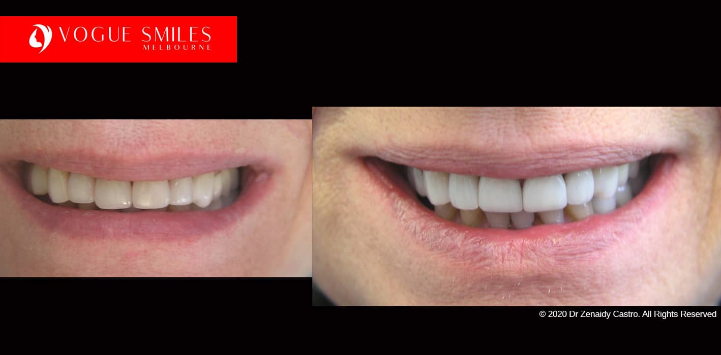 Full-Mouth-Reconstruction-complete-extreme-dental-makeover