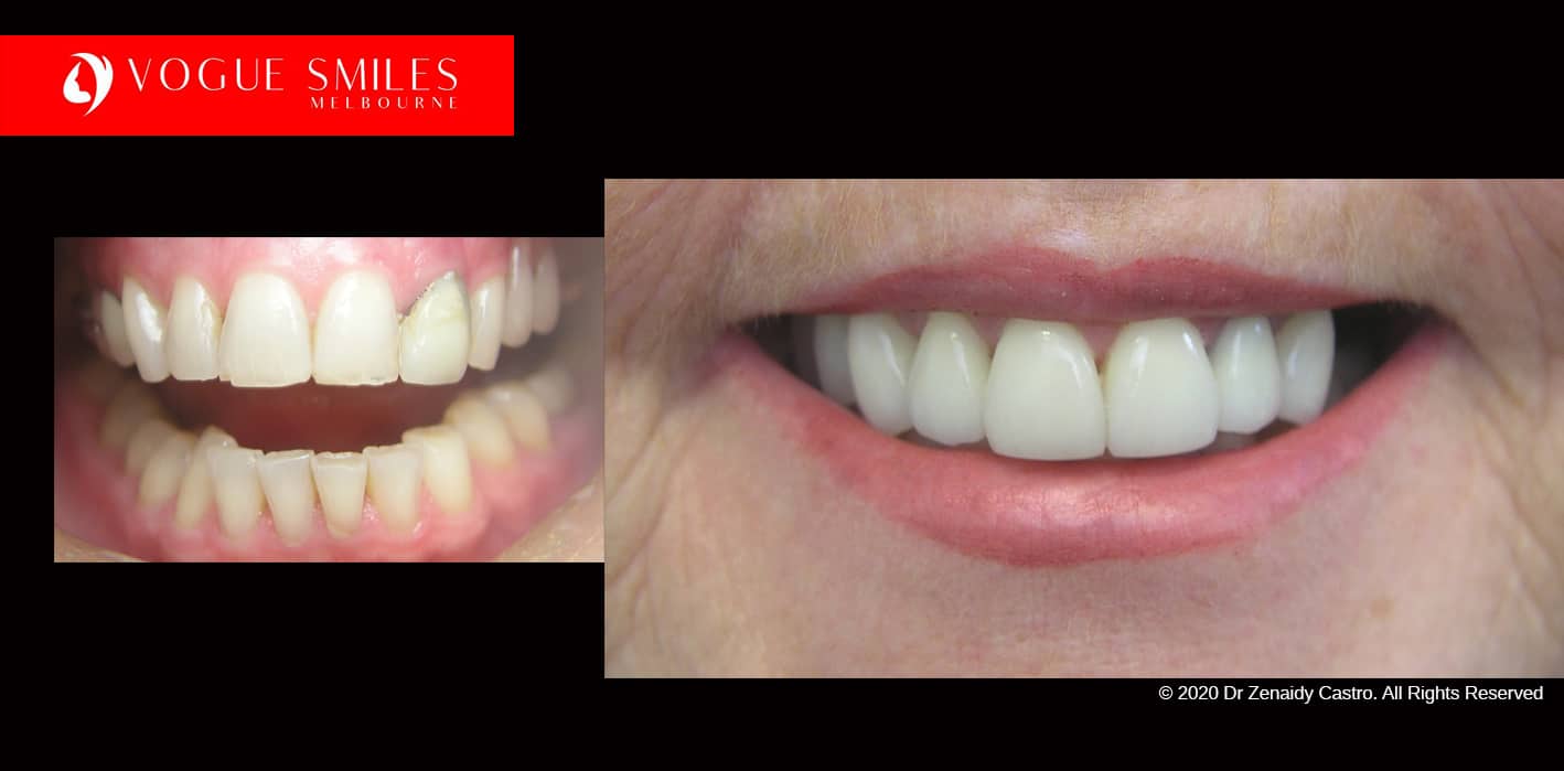 Full-Mouth-Reconstruction-complete-extreme-dental-makeover